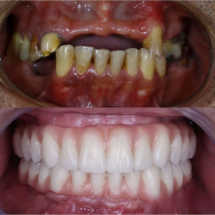 Dentadura de Silicone FIX | Ajustavel e Adaptativa
